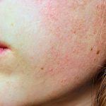 Cómo combatir la dermatitis